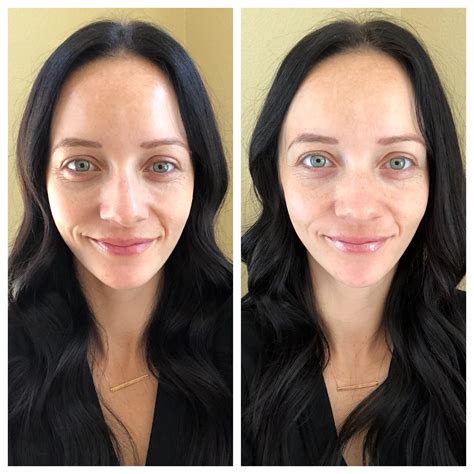 Glyton Chemical Peel Before And After Beauty Outfits And Outings