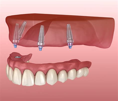 All On 4 Dental Implants In San Carlos Ca Common Mistakes