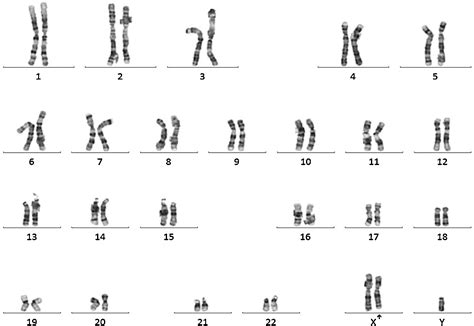 Klinefelter Syndrome With Fabry Disease A Case Of Nondisjunction Of The X Chromosome With Sex