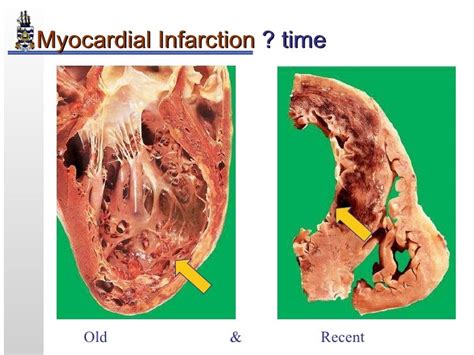 Pathology Of Myocardial Infarction
