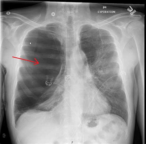 The Role Of Chest X Ray And Bedside Ultrasound In Diagnosing Pulmonary