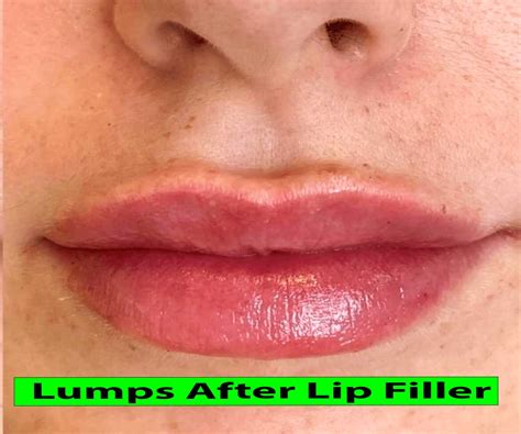 14 Lumps After Lip Filler Pros And Cons Healthy Anozo