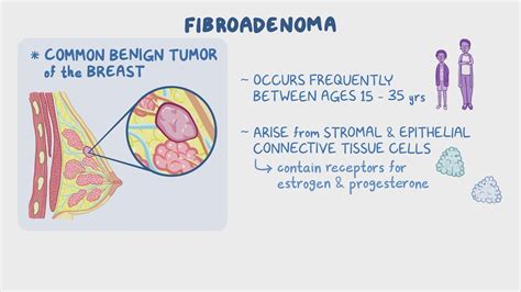 Fibroadenoma Clinical Sciences Osmosis Video Library