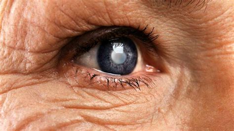 19 Warning Signs And Symptoms Of Cataract Surgery Complications Durin