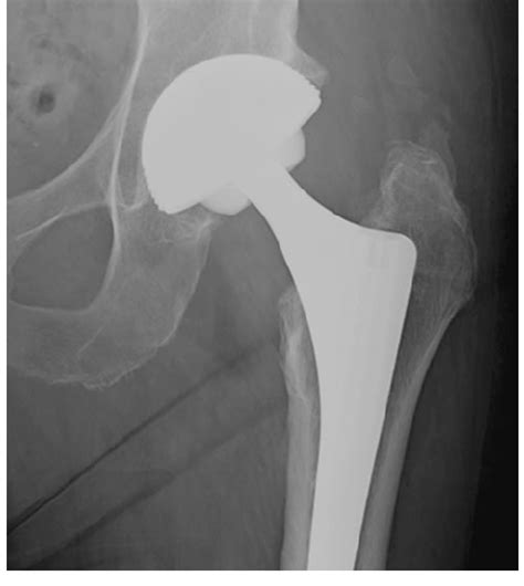 X Rays At 1 Year After Left Total Hip Arthroplasty In A 75 Year Old