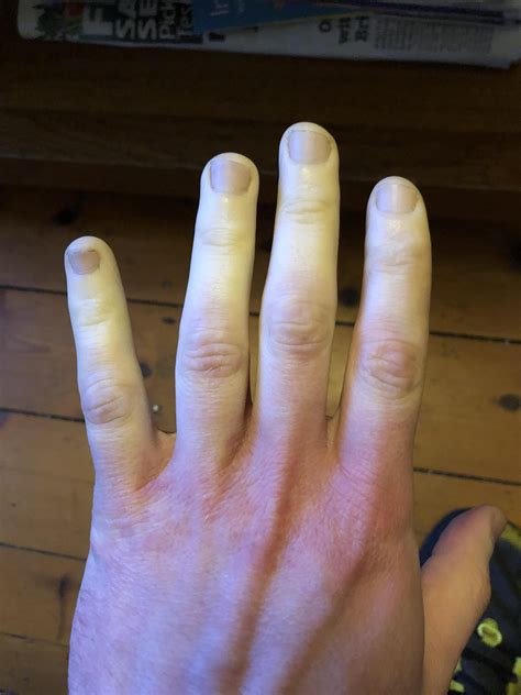 My Fingertips Is Burning at Jessie Jorgensen blog