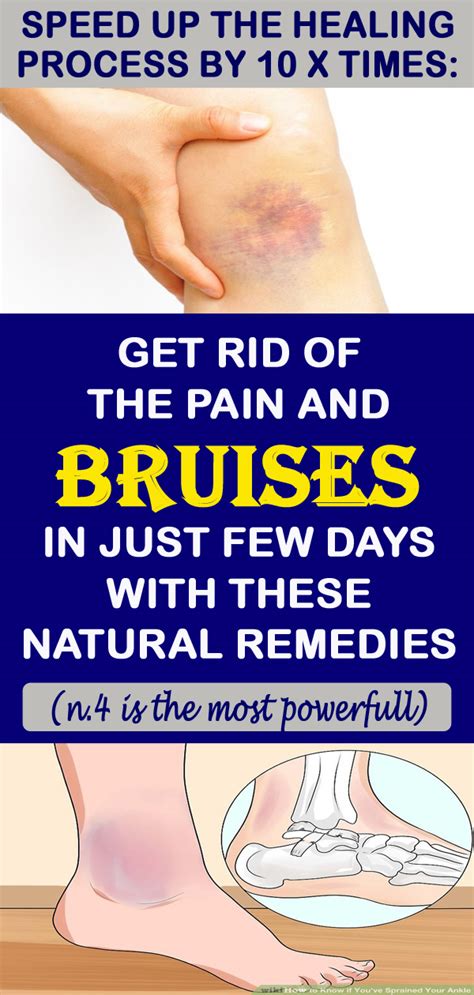 How To Get Rid Of Bruises Naturally World Of Health
