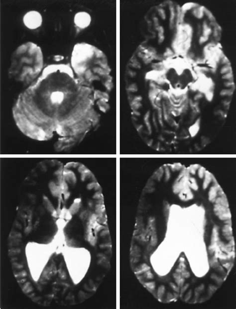Axial Mr T 2 Weighted Images Showing Enlarged Lateral And Third