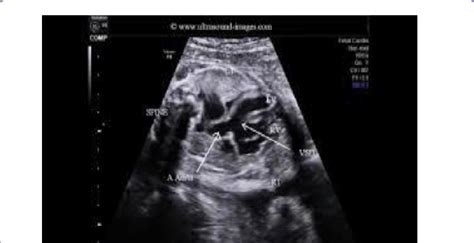Fetal Echocardiography Showing Vsd Setting Hypoplastic Rv In The