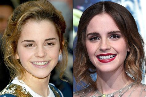 Celebrity Teeth Before And After Teeth Whitening Makeovers Pictures 2017
