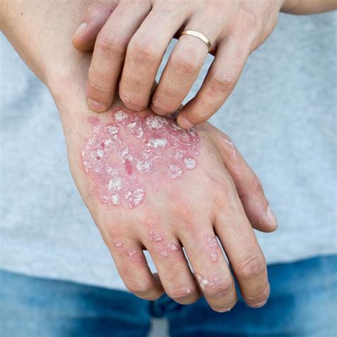 Psoriasis Is More Than Skin Deep Latest News For Doctors Nurses And
