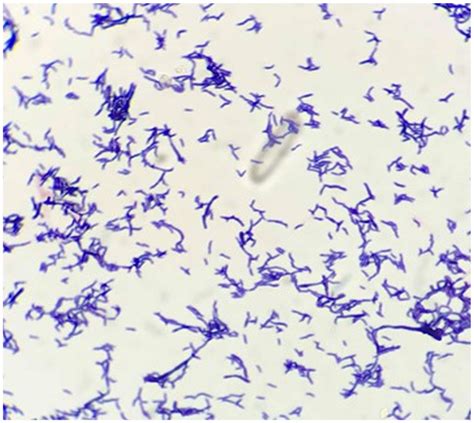 Bacterial Endocarditis Caused By Actinomyces Oris First Reported Case