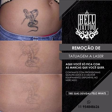 Hell Tattoo Despigmentação A Laser E Tatuagens Dá Pra Remover A Tatuagem