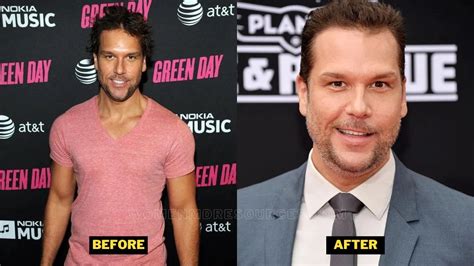 Dane Cook Plastic Surgery What Happened To Him And His Face