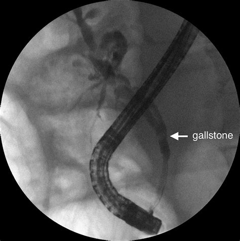 Common Bile Duct Intussusception During Ercp For Stone Removal Videogie