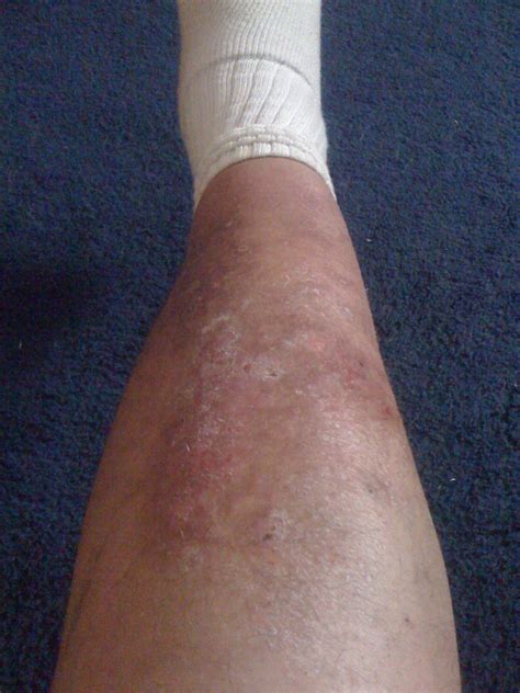 Rash From Swimmers Itch Turned Into Itching Addiction Now My Legs Are