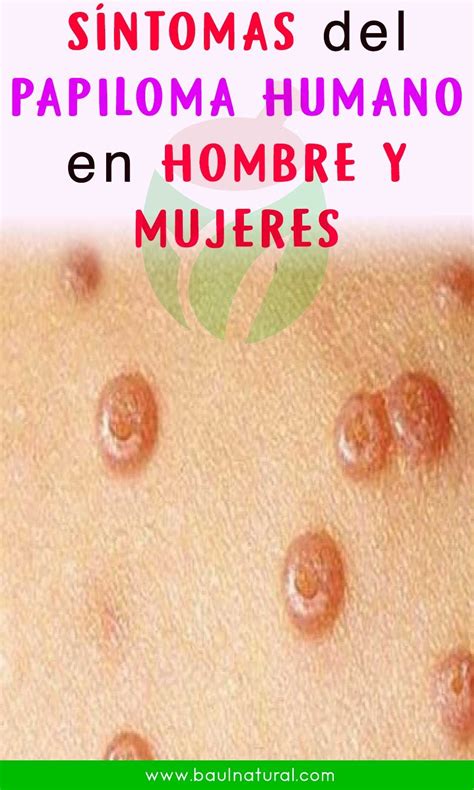 Virus Del Papiloma Humano En Hombres Esflip