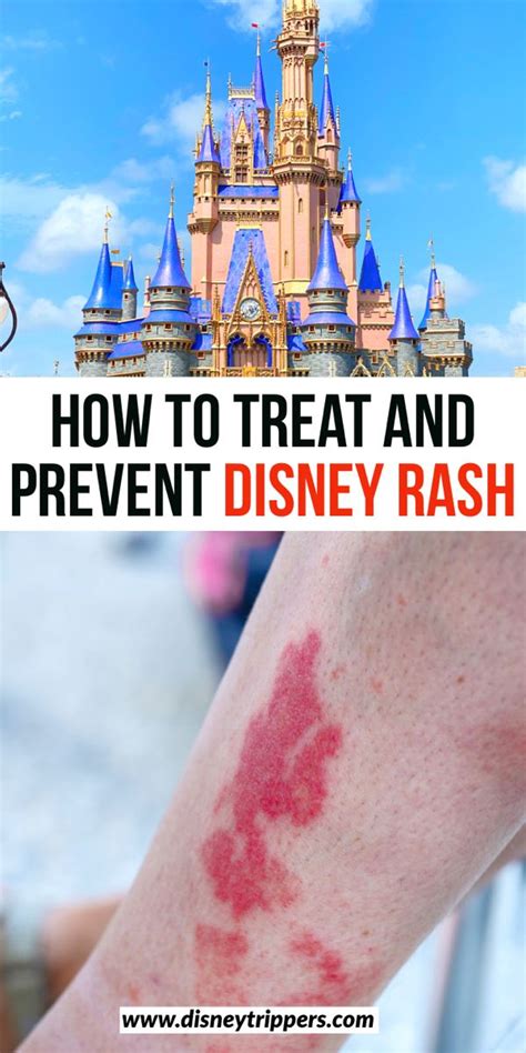 How To Treat And Prevent Disney Rash Disney Trippers Disney Rash