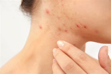 Dear Pimples Lets Break Up Not Break Out Acne Acnetreatment