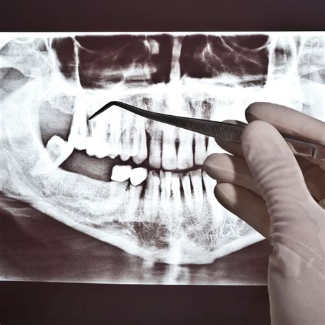 Why Do We Need Dental X Rays Ellicott Mills Dental
