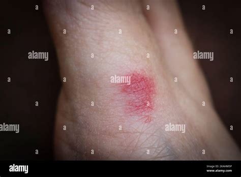 Ant Bite On The Skin Of The Foot Red Inflammation From Damage To Human
