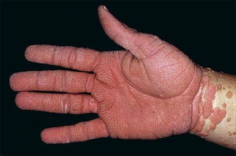 Regression Of Cutaneous Warts In A Patient With Wild Syndrome Following
