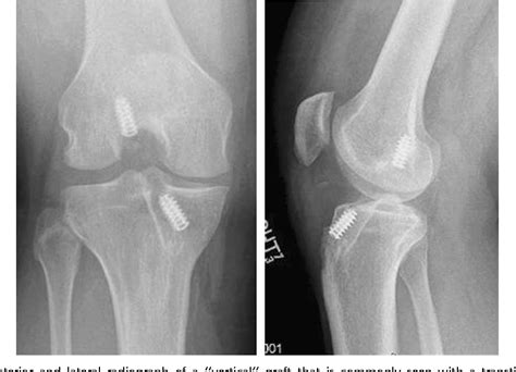 Figure 1 From Anatomic Revision Acl Reconstruction Semantic Scholar