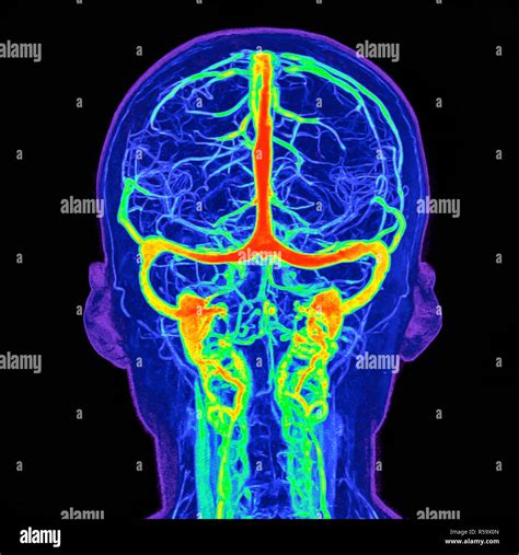 Intracranial Blood Vessels Illustration Based On A Coloured Magnetic