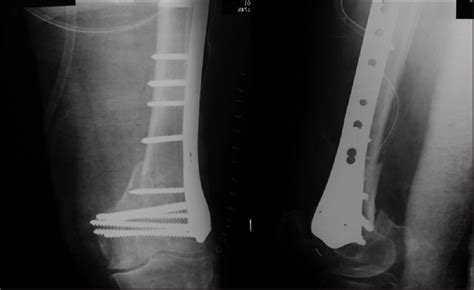 Distal femur locking plate for titanium medical orthopedic femoral bone fracture surgery implant va lcp. Distal femoral fractures fixed by distal femoral locking ...