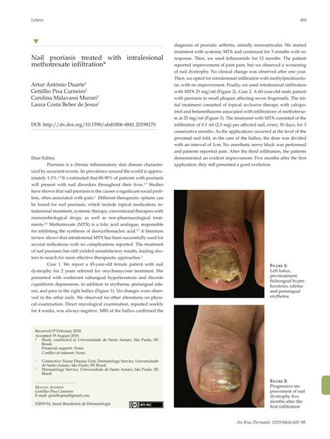 Pdf Nail Psoriasis Treated With Intralesional Methotrexate Infiltration