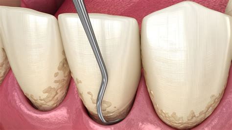 ¿en Qué Consiste El Curetaje Clínica Dental Iessodent