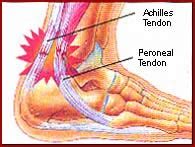 Human anatomy diagrams show internal organs. Ankle Tendonitis