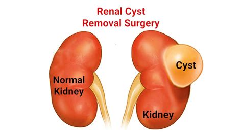 Kidney Cyst Symptoms Causes Diagnosis And Treatment