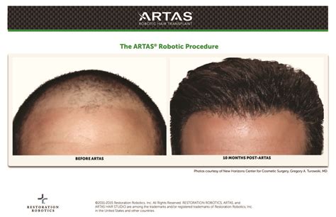 ARTAS Before And After Photos Hair Restoration Procedure