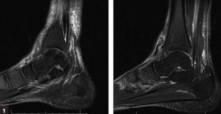 Related posts of foot muscle anatomy mri. A 44-year-old man with right ankle pain and weakness