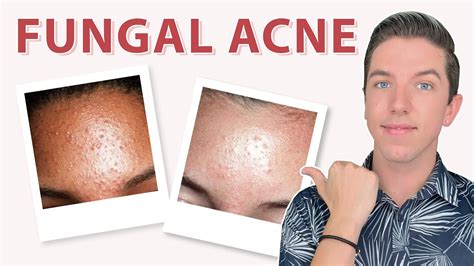 How To Get Rid Of Fungal Acne Hyram
