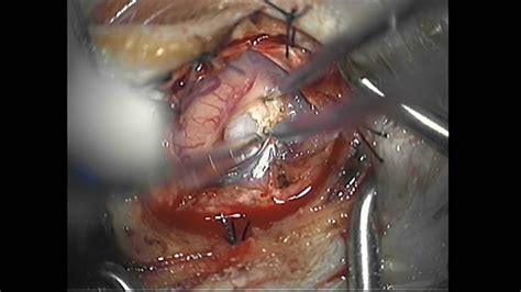 Changes in voice, headaches, sore throat or a cough may be symptoms of throat cancer. Microsurgical Resection of a Brain Tumor - YouTube