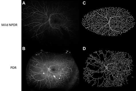 Characterization Of Ultra Widefield Angiographic Vascular Features In