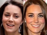 FOTO Kate Middleton prima e dopo: è rifatta?