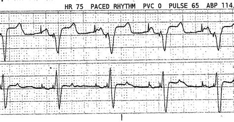 Ecg Rhythms Interesting Pacemaker Behavior