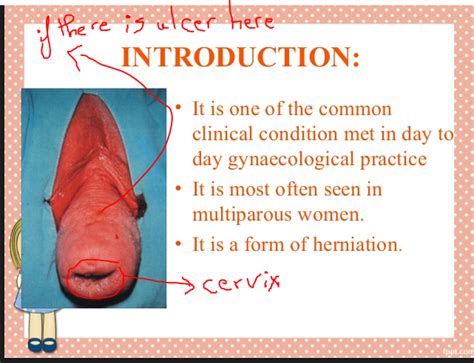 uterine prolapse pregnancy