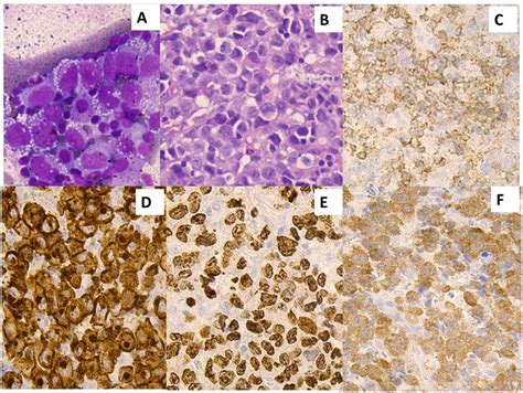 Anaplastic Large Cell Lymphoma Histology Numerous Large Tumor