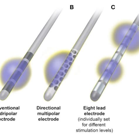 Deep Brain Stimulation Electrode Configurations A Conventional