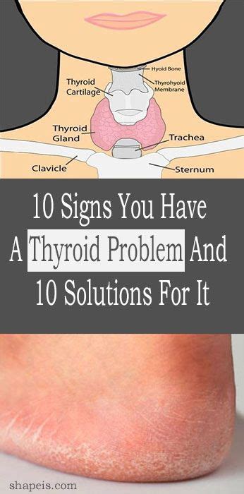 10 Signs You Have A Thyroid Problem And 10 Solutions For It With