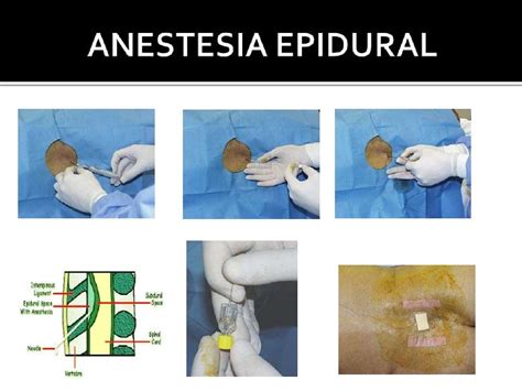Anestesia Epidural