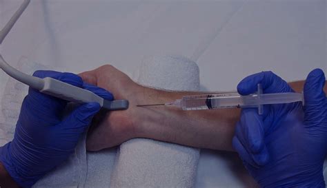 Tennis Elbow Steroid Injections Steroid Injections For Hand And Wrist