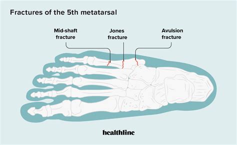 Fracture Of The 5th Metatarsal Types Symptoms And Treatment