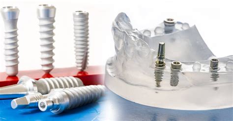 Dentist Malta Everything You Need To Know About Dental Implants
