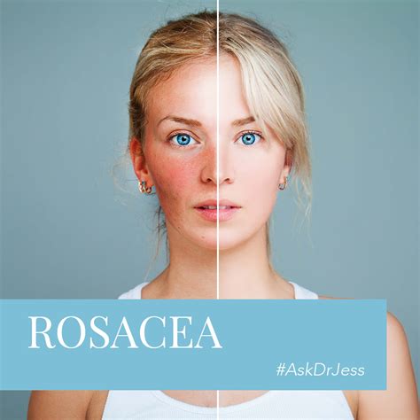 Askdrjess Rosacea Ocean Cosmetics Perths Cosmetic And Aesthetic Hub