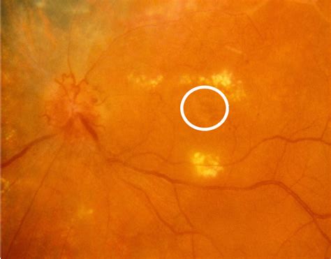 Foveal Geographic Atrophy Ga Of The Retinal Pigment Epithelium Rpe